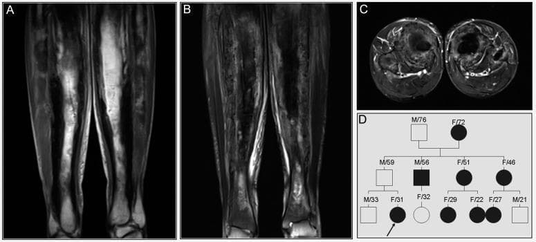 This composite educational graphic presents radiological and genetic data for a patient with Progressive Diaphyseal Dysplasia (PDD), also known as Camurati-Engelmann disease. Panels A, B, and C provide MRI views of the bilateral femora. Panel A (coronal T1-weighted image) demonstrates significantly thickened cortices with characteristic low signal intensity (SI). Panels B (coronal) and C (axial) utilize T2 fat suppression sequences to reveal heterogeneous signal intensity within the affected bone, indicating non-uniform bone marrow involvement and cortical changes. Key diagnostic features include irregular endosteal surfaces and a narrowed medullary cavity. Panel D contains a three-generation family pedigree illustrating an autosomal dominant inheritance pattern. The pedigree identifies the index case (proband) with an arrow, showing multiple affected individuals (black circles/squares) and an asymptomatic carrier (gray square). This visual set correlates clinical imaging findings of symmetric diaphyseal sclerosis and cortical thickening with genetic transmission, typical of hereditary sclerosing bone dysplasias.