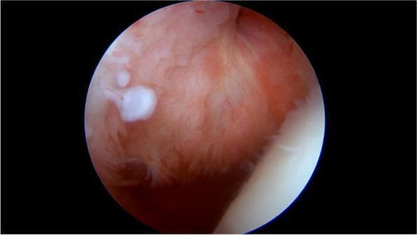 This arthroscopic clinical photograph captures an intra-articular view of the synovial membrane, likely within the shoulder joint. The primary finding is a well-defined, opaque, white cartilaginous body that is sessile, meaning it is directly attached to the underlying tissue without a stalk. The surrounding synovial membrane appears hyperemic and erythematous, characterized by a reddish-pink color and an irregular, frond-like or villous texture consistent with chronic synovitis. The border where the cartilaginous body arises from the synovia is somewhat irregular, showing a direct transition from the vascularized synovial tissue to the avascular hyaline cartilage structure. This visual representation is characteristic of primary synovial chondromatosis (PSC), a condition where the synovial lining undergoes metaplasia to form cartilaginous nodules. These nodules can eventually detach to become loose bodies within the joint space. The image serves as a clinical example of the early, attached phase of chondromatosis, demonstrating the macroscopic appearance and anatomical relationship between the metaplastic nodules and the inflamed synovial environment.
