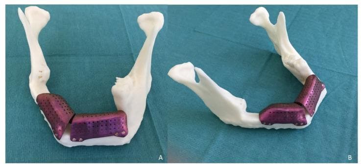 Educational photographs showcasing a 3D-printed stereolithographic (STL) model and custom-fabricated titanium meshes used for complex maxillofacial reconstruction. The white, opaque resin model represents a human mandible with visible anatomical landmarks, including the condylar processes, coronoid processes, rami, and mandibular body. Image (A) shows an anterior-oblique view, while image (B) provides a superior-oblique view of the horseshoe-shaped jaw structure. Adapted to the anterior and lateral mandibular regions are two CAD/CAM titanium meshes featuring a characteristic purple-metallic hue. These meshes exhibit a porous texture with regularly spaced 1.5 mm perforations to facilitate vascularization and bone graft integration. The meshes are precision-contoured to bridge a vertical bone discrepancy, specifically following a two-segment fibula flap reconstruction for ameloblastoma. Multiple screw holes are visible at the inferior margins, demonstrating the mechanical fixation strategy for maintaining an iliac crest bone graft. The visual illustrates the integration of virtual surgical planning (VSP) in treating large mandibular defects to restore vertical dimension and support future dental implant placement.