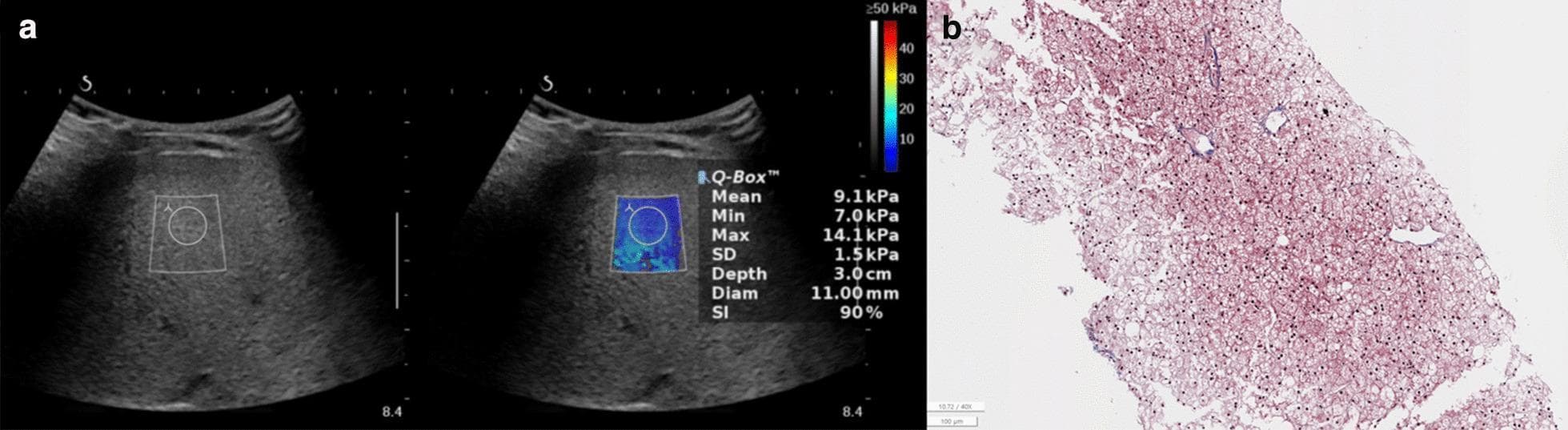 This composite educational image showcases diagnostic modalities for Glycogen Storage Disease of the liver in a pediatric patient. Panel (a) presents a Two-Dimensional Shear-Wave Elastography (2D-SWE) ultrasound. The B-mode image shows diffuse hyperechoic liver parenchyma. A superimposed color-coded elastography map within a region of interest (ROI) provides quantitative tissue stiffness data, indicating a mean stiffness of 9.1 kPa (suggestive of mild fibrosis). Quantitative metrics include a depth of 3.0 cm and a 90% success index (SI). Panel (b) is a histopathologic specimen stained to highlight architectural and cellular changes. It demonstrates diffuse hepatomegaly at the cellular level, with hepatocytes showing characteristic clear cytoplasm due to glycogen accumulation. There is notable enlargement of the portal tract with evidence of mild fibrosis, corresponding to a METAVIR score of F1. The image contrast between non-invasive imaging and gold-standard biopsy provides a comprehensive view of metabolic liver disease and its structural impact.