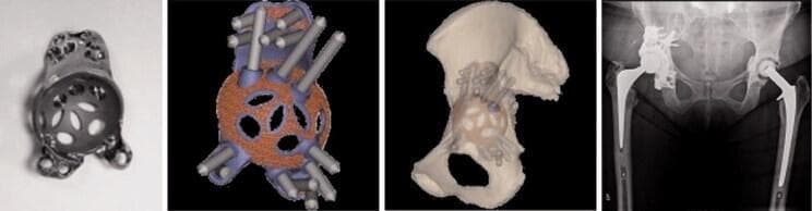 This composite figure illustrates the workflow for custom acetabular reconstruction in complex revision total hip arthroplasty. From left to right: The first panel shows a 3D-printed, patient-specific monobloc cup-cage titanium implant featuring a porous trabecular surface for biological fixation and multiple peripheral flanges with screw holes. The second panel displays a digital 3D planning model showing the intended screw trajectories through the implant into the surrounding pelvic bone. The third panel shows the implant integrated into a 3D CT-reconstructed model of the patient's hemipelvis, demonstrating preoperative planning for anatomical fit and center of rotation. The final panel is a postoperative anteroposterior (AP) pelvic radiograph confirming the successful bilateral hip replacement. The right hip demonstrates the custom-made acetabular cup-cage construct secured with multiple radiopaque screws, addressing a significant acetabular bone defect, alongside a prosthetic femoral stem. This visual demonstrates the application of computer-aided design (CAD) and additive manufacturing in orthopaedic surgery for treating Paprosky-type acetabular defects.
