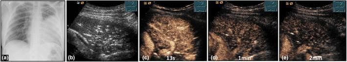 Multi-modal diagnostic imaging series illustrating community-acquired lobar pneumonia in a 30-year-old patient. (a) Posterior-anterior chest X-ray shows a clear area of consolidation in the left upper lobe. (b) B-mode lung ultrasound (LUS) reveals a complex, hypoechoic consolidation containing numerous hyperechoic punctate and linear structures, characteristic of a marked air bronchogram. (c-e) Contrast-enhanced ultrasound (CEUS) time-series demonstrates perfusion dynamics: (c) at 13 seconds, there is homogeneous pulmonary arterial enhancement; (d) by 1 minute, significant early washout occurs; (e) by 2 minutes, the washout is more pronounced. This specific CEUS pattern of rapid washout is indicative of pulmonary arterial vasoconstriction, often associated with the Euler–Liljestrand mechanism in response to local hypoxia in consolidated lung tissue. The series serves as an educational example of how multi-phase CEUS can supplement B-mode ultrasound and radiography in characterizing the hemodynamic response of pulmonary parenchyma during inflammatory processes.