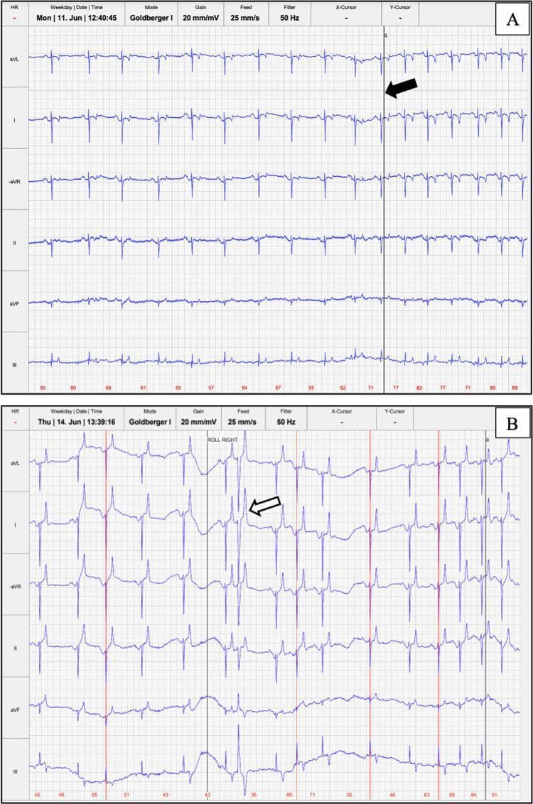 This diagnostic image displays two panels of telemetric electrocardiogram (ECG) recordings. Panel A demonstrates a normal respiratory sinus arrhythmia in a patient with a type B cardiac conduction system, characterized by a cyclical variation in heart rate synchronized with the respiratory cycle, indicated by a vertical black line and arrow marking inspiration. The six-lead view (aVL, I, -aVR, II, aVF, and III) shows predominantly negative depolarization in lead II and the base-apex modified lead I. Panel B illustrates the same six leads showing respiratory sinus arrhythmia complicated by an isolated ventricular premature complex (VPC), marked by a white arrow. The VPC is distinguished by its premature timing, widened QRS morphology, and absence of a preceding P wave. Both recordings are captured at a paper speed of 25 mm/s and a gain of 20 mm/mV over a 16-second sweep, providing a clinical comparison between physiological rhythm variation and pathological premature ventricular activation.