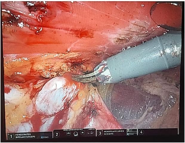 This clinical photograph is an intraoperative endoscopic view from a robotic-assisted surgical procedure, specifically an extended totally extraperitoneal repair (eTEP) for a paraumbilical hernia and rectus diastasis. The image demonstrates a 'cross-over' technique used to dissect and communicate both retrorectus spaces. The surgical field displays varied tissue textures: the upper portion shows striated red muscle tissue with visible small vessels, while the central area reveals white, glistening fascial planes and globular preperitoneal fat. A robotic surgical instrument, identified as monopolar curved scissors, is positioned at the dissection plane to perform sharp and blunt dissection between the retrorectus and preperitoneal spaces. The digital interface at the bottom of the screen provides telemetry for the robotic system, confirming the use of fenestrated bipolar forceps and monopolar curved scissors. This visual highlights the precise tissue handling and clear visualization of anatomical planes required for complex abdominal wall reconstruction.