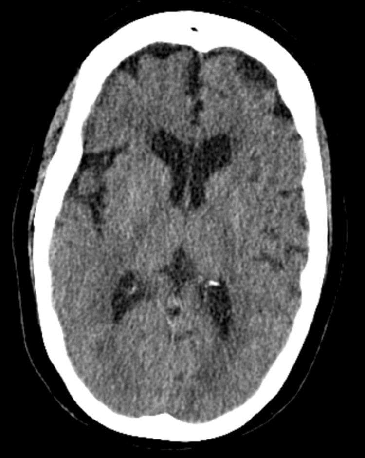 This diagnostic image is an axial non-contrast computed tomography (CT) scan of the head at the level of the lateral ventricles and basal ganglia. The image demonstrates normal intracranial anatomy for educational comparison. The brain parenchyma shows appropriate differentiation between gray and white matter with no evidence of acute hemorrhage, mass effect, or focal infarcts. The ventricular system, including the frontal horns of the lateral ventricles and the third ventricle, is centrally located and of normal size (hypodense appearance due to cerebrospinal fluid). The midline is unremarkable, with a centrally aligned falx cerebri and no evidence of midline shift. Cortical sulci and sylvian fissures are visible and of normal prominence for age. The surrounding calvarium is intact and typically hyperdense (bright white) on this soft tissue window setting. This scan serves as a clinical reference for a negative or 'normal' head CT in an emergency or neurological assessment context.
