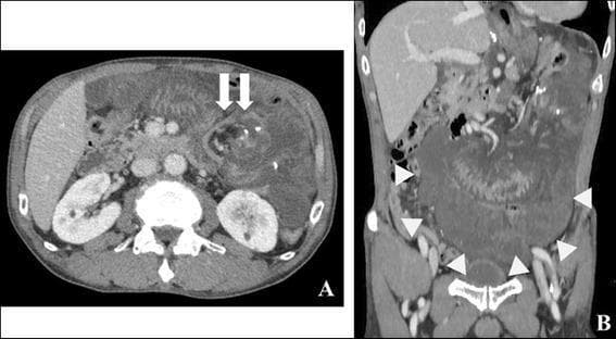 This diagnostic image consists of two panels showing a contrast-enhanced computerized tomography (CT) scan of the abdomen in axial (A) and coronal (B) planes. The scans demonstrate findings characteristic of an internal hernia and small bowel obstruction. In the axial view (A), white arrows highlight a 'whirl sign,' which is a swirling or spiral appearance of the mesenteric fat and vessels, indicating mesenteric torsion. The axial section also shows the relationship of the pathology to the liver and kidneys, with fluid (ascites) visible in the perihepatic and perisplenic spaces. In the coronal view (B), white arrowheads delineate a 'closed-loop formation' of the small intestine, characterized by a U-shaped or C-shaped cluster of dilated bowel loops. The bowel walls appear thickened, and there is evidence of surrounding free peritoneal fluid. These visual markers are critical diagnostic indicators for surgeons and radiologists to identify strangulated bowel or volvulus requiring urgent intervention.