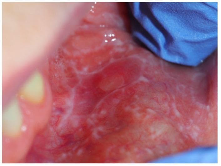 A clinical photograph displaying the buccal mucosa of a patient with oral lichen planus (OLP). The image shows a classic presentation of the reticular form of the disease, characterized by Wickham striae—a network of fine, white, slightly raised interlacing lines forming a lace-like pattern. These white lines are superimposed on an erythematous (reddened) mucosal background, indicating active inflammation. Within the center of the reticular network, a small, circular, pale-colored lesion is visible, alongside areas suggestive of early erosive or atrophic changes. The distribution of the striae is non-uniform, with denser concentrations in specific mucosal regions. This visual representation serves as a key educational example of an oral potentially malignant disorder (OPMD) and highlights the characteristic autoimmune-mediated mucosal changes necessary for clinical diagnosis and dermatological/stomatological assessment.