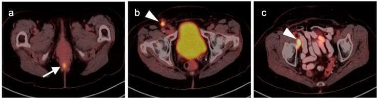 This diagnostic image consists of three axial fused 18F-FDG PET-CT slices of the pelvis demonstrating the staging of anal carcinoma. (a) An axial slice at the level of the perineum shows a focal area of intense FDG uptake (hypermetabolism) in the posterior midline, corresponding to the primary anal tumor (white arrow). (b) A more superior axial slice demonstrates a hypermetabolic right superficial inguinal lymph node (white arrowhead), indicating regional nodal spread. (c) A slice at the level of the mid-pelvis shows an intensely hypermetabolic right distal external iliac lymph node (white arrowhead), representing further lymphatic dissemination along the iliac chain. The images illustrate the typical cephalad and lateral lymphatic drainage patterns of anal malignancy. These findings are critical for oncologic staging and treatment planning, distinguishing between localized disease and regional nodal involvement. The bladder shows normal physiological tracer excretion in frames (b) and (c).