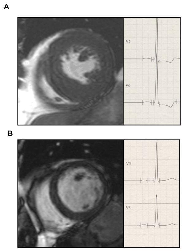 This comparative medical illustration presents short-axis Cardiac Magnetic Resonance (CMR) images and corresponding Electrocardiogram (ECG) tracings for two types of Left Ventricular Hypertrophy (LVH). Panel A demonstrates concentric LVH, characterized by a significantly thickened myocardial wall and a reduced left ventricular (LV) end-diastolic cavity diameter (42 mm). The adjacent ECG shows high-voltage R waves in leads V5 and V6 with accompanying ST-segment depression and T-wave inversion, consistent with a left ventricular strain pattern. Panel B illustrates eccentric LVH, featuring a dilated LV cavity (end-diastolic diameter 60 mm) and relatively thinner myocardial walls compared to the concentric model. The corresponding ECG in panel B shows high-voltage R waves but with upright T waves and less pronounced ST-segment changes. The visual comparison highlights the structural differences between pressure-overload (concentric) and volume-overload (eccentric) remodeling and their respective electrophysiological manifestations, facilitating the study of cardiac morphology and ECG-LVH correlation criteria.