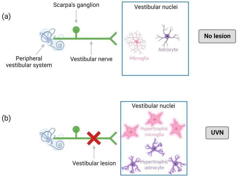 This medical pathophysiology diagram illustrates the neuroinflammatory response in the vestibular system following a unilateral vestibular neurectomy (UVN). The diagram is divided into two panels: (a) 'No lesion' and (b) 'UVN'.
Panel (a) depicts a healthy peripheral vestibular system connected to the brainstem via the vestibular nerve and Scarpa's ganglion. Within the vestibular nuclei, microglia and astrocytes are shown in their quiescent state, characterized by small cell bodies and thin, ramified processes.
Panel (b) demonstrates the pathophysiological state following a vestibular lesion (marked by a red 'X'). This deafferentation triggers a central inflammatory response within the vestibular nuclei. The diagram shows a proliferation and morphological change in glial cells, specifically highlighting hypertrophic microglia and hypertrophic astrocytes. These cells are depicted with enlarged cell bodies and thickened, more numerous processes, signifying reactive gliosis. This model serves to explain the cellular mechanisms of central compensation and neuroinflammation in acute unilateral peripheral vestibulopathy (AUPV).