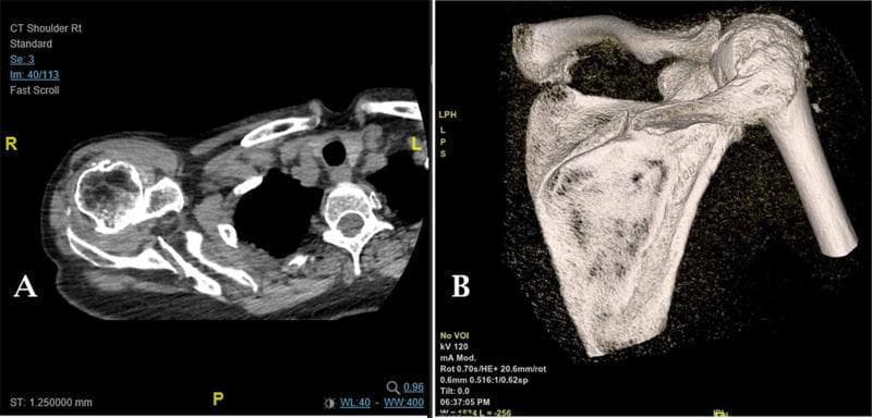This composite diagnostic image features the right shoulder of a human patient, displaying a Computed Tomography (CT) scan in two formats. Panel A shows an axial CT slice demonstrating the cross-sectional anatomy of the glenohumeral joint. Key findings include superior migration of the humeral head, severe joint space narrowing, and subchondral sclerosis, consistent with rotator cuff arthropathy. A cortical discontinuity is visible in the posterior aspect of the scapular spine, indicating a fracture. Panel B presents a three-dimensional (3D) reconstruction of the same shoulder. The reconstruction clearly illustrates a non-union fracture involving the medial third of the scapular spine. Additionally, the 3D view shows marked erosion of the acromion and an irregular glenohumeral articulation. The bone texture appears osteopenic and irregular. These findings are clinically relevant for diagnosing chronic atraumatic scapular fractures in the setting of severe rotator cuff deficiency and possible corticosteroid-induced bone loss.