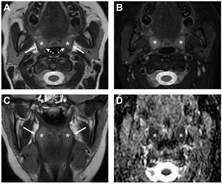 This diagnostic imaging panel demonstrates the normal MRI anatomy of the oropharynx in a pediatric patient across four sequences: (A) axial T2-weighted, (B) axial fat-suppressed T2-weighted, (C) coronal T2-weighted, and (D) an Apparent Diffusion Coefficient (ADC) map. The primary focus is the palatine tonsils (asterisks), which exhibit intermediate to high signal intensity on T2-weighted images due to lymphoid tissue content. Anatomical relationships are clearly demarcated: the tonsils are bounded laterally by the superior constrictor muscles (solid white arrows) and posteriorly by the palatopharyngeus muscles (dotted white arrows). In sequence B, fat suppression enhances the contrast between the tonsillar tissue and surrounding soft tissues. Image D shows the ADC map where the palatine tonsils demonstrate low signal intensity, indicating innately restricted diffusion characteristic of highly cellular lymphoid tissue. This comparison is clinically significant for differentiating normal physiologic prominent tonsils in children from pathological processes like tonsillitis or peritonsillar abscesses.