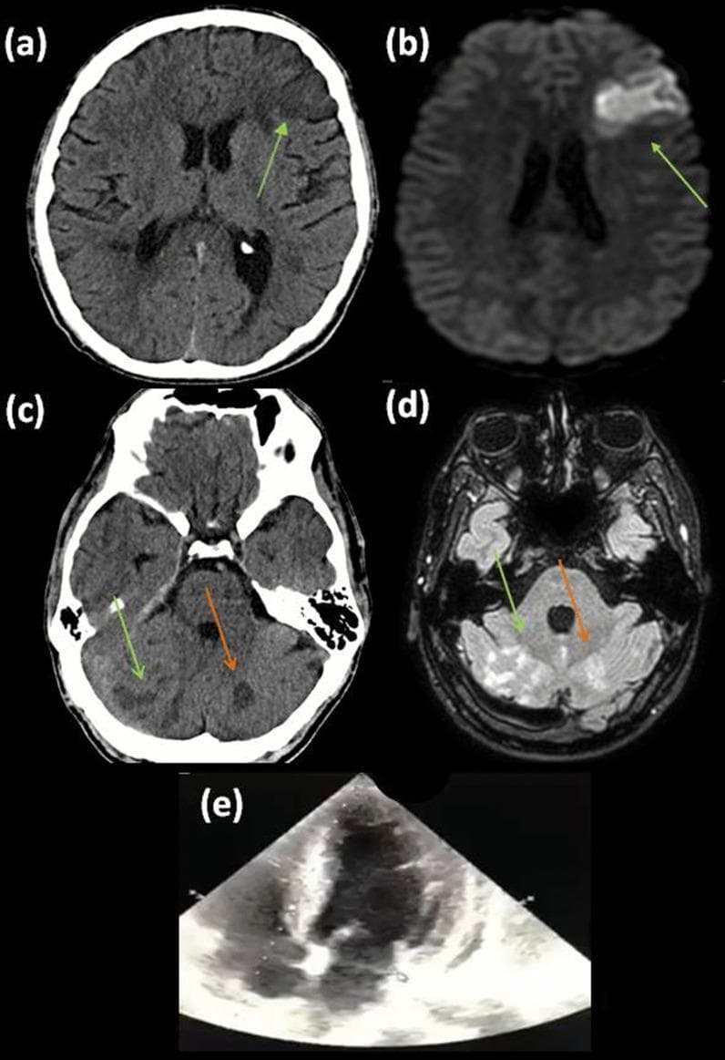 This composite figure illustrates a case of multi-territory embolic ischemic strokes and cardiac imaging. (a) Non-contrast axial CT scan of the brain shows a faint hypodense area in the left frontal lobe. (b) Corresponding Diffusion-Weighted Imaging (DWI) MRI confirms an acute infarct in the left middle cerebral artery (MCA) superior trunk territory, appearing as a bright, hyperintense signal indicating restricted diffusion. (c) A more caudal axial CT slice reveals multiple small hypodense lesions in the right cerebellar hemisphere and vermis (green arrows), alongside an older, well-defined hypodense chronic infarct in the left cerebellar hemisphere (orange arrow). (d) Fluid-Attenuated Inversion Recovery (FLAIR) MRI at the same level as (c) shows these acute/subacute cerebellar lesions as hyperintense signals (green arrows) and the chronic left-sided infarct (orange arrow). (e) Transthoracic echocardiogram (TTE), apical four-chamber view, demonstrating the resolution (lysis) of a previously documented left ventricular thrombus. The series highlights the importance of multimodal imaging (CT, MRI-DWI/FLAIR) and cardiac assessment in the evaluation of cardioembolic stroke.