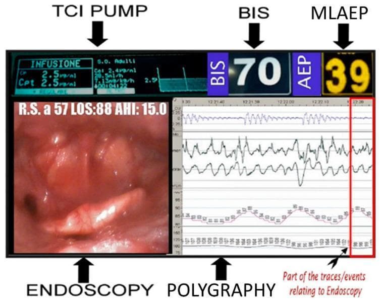 A comprehensive 'all-in-one' integrated monitor display used during Drug-Induced Sleep Endoscopy (DISE), specifically the 5VsEs prototype. The single-screen interface synchronizes five critical data sources for real-time airway evaluation. 1) Top Left: TCI (Target Controlled Infusion) pump monitor showing propofol infusion parameters (CP and Cpt at 2.5 µg/ml). 2) Top Right: Sedation depth monitors displaying a Bispectral Index (BIS) of 70 and Middle Latency Auditory Evoked Potential (MLAEP) value of 39. 3) Bottom Left: High-definition endoscopic view of the upper airway, specifically the oropharynx/laryngeal inlet, annotated with patient clinical data (e.g., AHI 15.0). 4) Bottom Right: A polygraphy section displaying synchronized waveforms including respiratory effort, oxygen saturation trends, and heart rate. A red vertical line indicates the temporal alignment between the endoscopic visual and the physiological traces. This diagnostic setup is designed to correlate pharyngeal collapse patterns with specific anesthetic concentrations and respiratory events during induced sleep, optimizing surgical decision-making for obstructive sleep apnea (OSA).