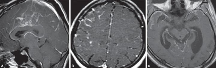 This composite diagnostic image features three panels (A, B, and C) illustrating neuroimaging findings associated with bacterial meningitis and its complications. Figures A and B are contrast-enhanced MRI scans in sagittal and axial planes, respectively, demonstrating diffuse leptomeningeal and pachymeningeal enhancement. This pathological enhancement is particularly prominent along the cerebral convexities and within the basal cisterns, signifying active meningeal inflammation and hypervascularity. Figure C is an axial T1-weighted post-contrast MRI scan showing significant bilateral enlargement of the lateral ventricles. The ventricular system appears markedly dilated with blunting of the frontal horns, characteristic of obstructive hydrocephalus secondary to the inflammatory exudates of meningitis interfering with cerebrospinal fluid (CSF) flow. Collectively, the images provide a clinical demonstration of acute intracranial infection manifesting as diffuse meningeal inflammation and subsequent hydrocephalus, useful for teaching the radiological hallmarks of central nervous system infections.