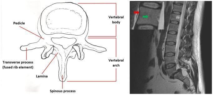 This educational composite compares anatomical structures of the human vertebrae through an anatomical diagram and magnetic resonance imaging. On the left, a coronal anatomical diagram labels the primary components of a single vertebra, including the vertebral body, vertebral arch, pedicle, lamina, spinous process, and transverse process (fused rib element). On the right, a sagittal T2-weighted MRI slice demonstrates the lumbar and lower thoracic spinal column. The MRI shows a sequential stacked configuration of rectangular vertebral bodies separated by intervertebral discs, exhibiting normal spinal curvature. An inset enlargement of one vertebral body uses color-coded arrows to highlight signal intensity variations: a red arrow indicates the cortical bone, which appears as a low-signal (dark) outer boundary, while a green arrow points to the cancellous bone/medullary space inside the vertebral body, characterized by a higher-signal (brighter) grayscale intensity. Posterior to the vertebral bodies, the high-signal cerebrospinal fluid within the spinal canal is clearly visible. This material is designed for medical students to understand spinal anatomy and T2-weighted radiological findings.
