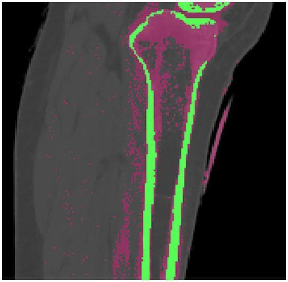 This diagnostic image is a color-coded 2D cross-section of a human leg, derived from CT imaging of the proximal tibia and fibula. The visualization uses threshold-based segmentation to distinguish between different bone compositions for orthopedic modeling. The cortical bone (compact bone) is highlighted in bright green, forming a thick, dense outer shell along the diaphysis and maintaining structural integrity. The cancellous bone (trabecular or spongy bone) is represented in rose pink, primarily concentrated within the proximal epiphysis and metaphysis. This distribution highlights the anatomical transition from the high-density load-bearing cortical shaft to the internal network of cancellous bone at the joints, which facilitates force distribution. This image serves as a foundational step for biomechanical finite element analysis, such as simulating tibial plateau fractures or assessing the impacts of osteoporosis on bone density and surgical fixation stability.