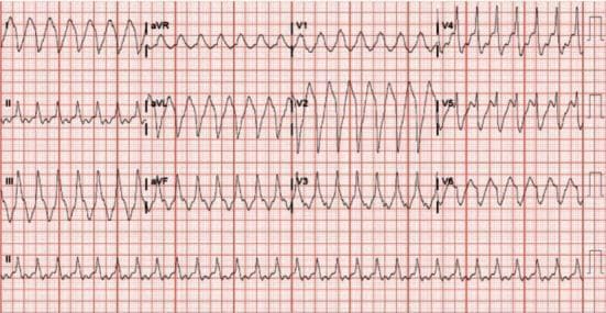 A 12-lead electrocardiogram (ECG) demonstrating a regular, wide-complex tachycardia. The ventricular rate is approximately 170-174 beats per minute with a significantly prolonged QRS duration of approximately 270 ms. The rhythm is monomorphic, showing consistent QRS morphology across all leads. Distinct P waves are not clearly visible, appearing to be obscured by the wide QRS complexes or the subsequent T waves. The tracing shows a classic 'sine-wave' or slurred appearance in several leads, particularly the precordial leads V2-V4, which is characteristic of severe QRS widening. The clinical context suggests a differential diagnosis including ventricular tachycardia, supraventricular tachycardia with aberrancy (bundle branch block), or toxicological effects causing slowed intraventricular conduction, such as flecainide toxicity. The image serves as a key educational example for identifying wide-complex tachycardias and assessing QRS morphology and intervals in an acute cardiology or emergency medicine setting.