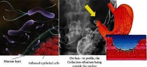 This composite educational illustration details the pathogenesis and clinical imaging of a peptic ulcer. The left panel features a pathophysiology diagram showing purple, flagellated Helicobacter pylori bacteria penetrating a green mucous layer to reach red, inflamed epithelial cells, representing the primary infectious cause of gastric irritation. The center-right panel integrates diagnostic and anatomical content, featuring a grayscale barium swallow X-ray alongside a red anatomical diagram of the stomach. A yellow arrow on the X-ray identifies a barium collection outside the normal gastric outline, characteristic of an ulcer crater (ulcer niche). A supplementary cross-sectional illustration provides a microscopic view of the ulcer, depicting a blue-shaded crater penetrating through the mucosal and submucosal layers into the underlying tissue. This graphic is intended for medical students to understand the transition from microbial infection to macroscopic tissue damage and its subsequent appearance in radiological imaging.