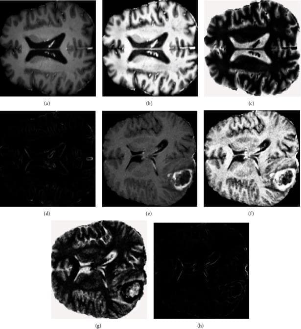 This composite image displays axial MRI brain scans processed through neutrosophic domain transformations for tumor classification. The figure is divided into two rows: the top row (a-d) represents a benign brain tumor case, while the bottom row (e-h) illustrates a malignant tumor case. For each case, four distinct states are shown: (a, e) Original T1-contrast enhanced (T1ce) MRI slices showing the anatomical structure and tumor mass; (b, f) the Truth (T) domain transformation, which enhances contrast and edge definition of the tumor and brain parenchyma; (c, g) the Falsity (F) domain, representing non-membership or background components with inverted intensity; and (d, h) the Indeterminacy (I) domain, which isolates regions of high uncertainty, specifically highlighting the edges and boundaries of the pathological mass and ventricles. The malignant case (e) demonstrates a more heterogeneous mass with clearer contrast enhancement compared to the benign case. This visualization facilitates the extraction of statistical texture features used in neural network-based diagnostic systems to differentiate between low-grade and high-grade gliomas.