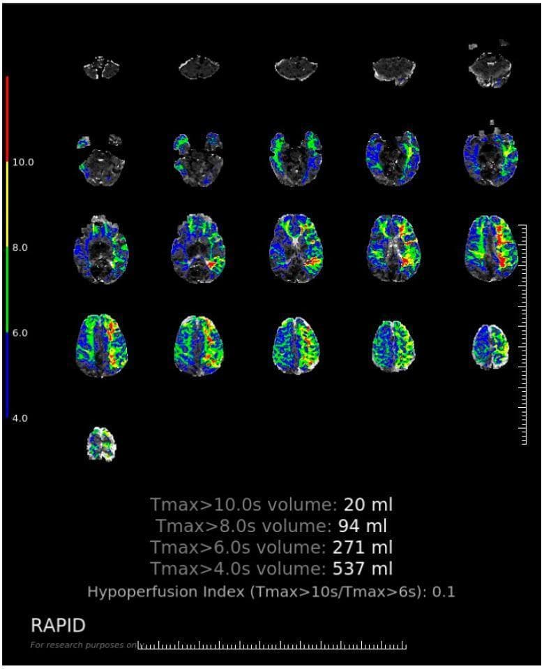 This diagnostic image displays a CT Perfusion (CTP) Tmax map of the human brain, commonly used in the acute management of ischemic stroke to assess the penumbra. The layout consists of multiple axial slices arranged in a grid, showing a large area of hypoperfusion throughout the left cerebral hemisphere. A color-coded scale on the left correlates Tmax values (measured in seconds) with specific colors: blue/green for lower delays (>4s) and yellow/red for higher delays (>10s). The visualization demonstrates an extensive perfusion deficit involving the left middle cerebral artery (MCA) territory. Quantitative data provided at the bottom indicates a tiered volumetric analysis: Tmax >4.0s (537 ml), Tmax >6.0s (271 ml), Tmax >8.0s (94 ml), and Tmax >10.0s (20 ml). A 'Hypoperfusion Index' (Tmax >10s / Tmax >6s) of 0.1 is calculated, which is a clinical metric used to assess the severity of collateral flow failure and predict the rate of infarct core expansion. The educational focus is on identifying tissue at risk versus severely hypoperfused regions using automated RAPID software processing.