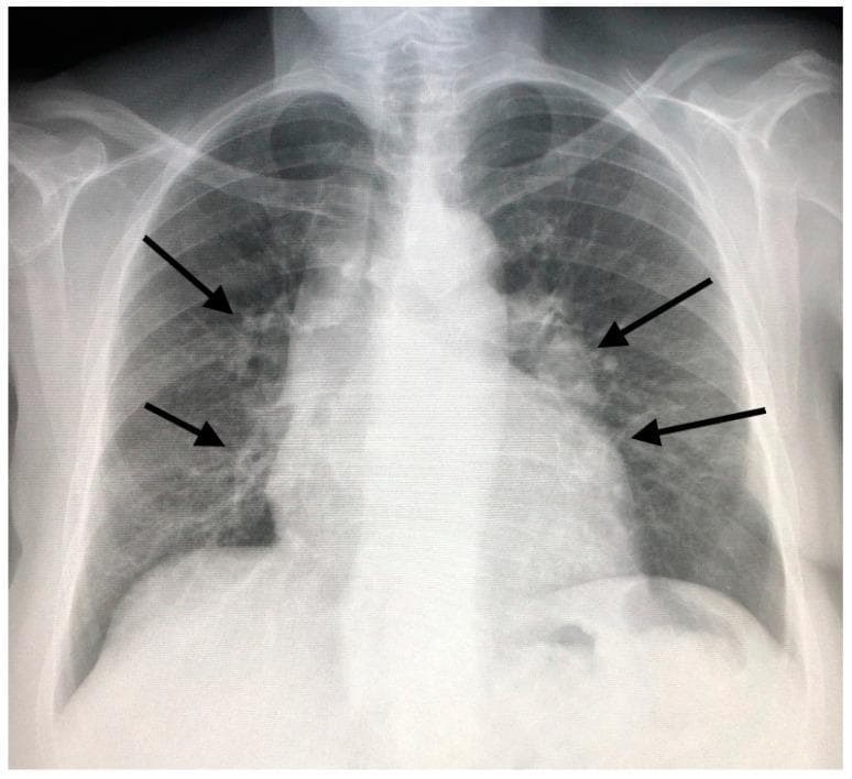 This diagnostic image is a posteroanterior (PA) chest X-ray of an adult patient. The primary findings include bilateral, diffuse pulmonary infiltrates characterized by reticulonodular opacities distributed throughout the lung fields. There is notable minimal widening of the mediastinum, particularly in the hilar and paratracheal regions, indicated by black arrows. These visual features—bilateral hilar lymphadenopathy combined with parenchymal lung disease—are consistent with Stage II sarcoidosis according to the Scadding classification system. The heart size appears within normal limits, and the costophrenic angles are clear. This image serves as a clinical example of interstitial lung disease (ILD) where the radiographic pattern suggests a granulomatous process. Educational focus is placed on recognizing the combination of adenopathy and infiltrative patterns in the diagnosis of thoracic sarcoidosis.
