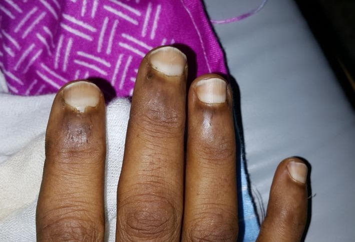 This clinical photograph displays the fingernails of a patient's hand, demonstrating the characteristic appearance of Lindsay's nails, also known as half-and-half nails. The visual presentation features a distinct transverse bicolor distribution across the nail plates. The proximal portion (closest to the cuticle) appears dull, opaque, or whitish, while the distal portion (occupying approximately 20% to 60% of the nail bed) exhibits a dark brown or reddish-brown discoloration. The boundary between these two zones is sharply demarcated. This finding is a specific dermatological sign highly associated with chronic kidney disease (CKD) and uremia, specifically end-stage renal disease (ESRD). The photograph serves as a diagnostic educational tool for identifying systemic manifestations of renal failure through nail bed examination. The nail texture remains largely smooth without significant ridging or pitting, focusing the clinical significance on the vascular bed discoloration.