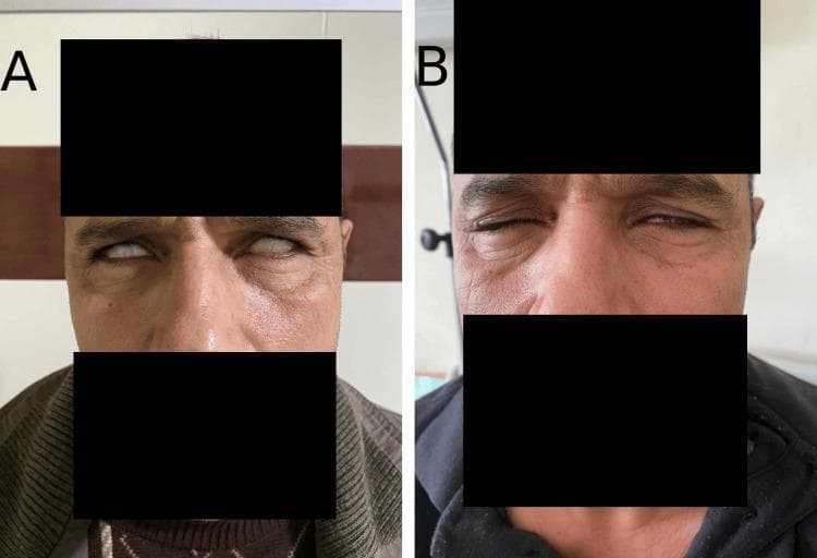 Clinical photograph presenting a side-by-side comparison (Panel A and Panel B) of a patient with facial diplegia associated with Guillain-Barré syndrome. Panel A shows the patient at admission, exhibiting bilateral peripheral facial paralysis. Key clinical signs include lagophthalmos and Bell’s phenomenon, characterized by the inability to close the eyelids and the upward rotation of the eyeballs when attempting closure. There is a lack of animation and significant periorbital strain. Panel B demonstrates clinical resolution one month after presentation and treatment. There is a marked improvement in orbicularis oculi muscle function, as evidenced by the patient's ability to partially close the eyelids and a more relaxed facial expression with reduced periorbital edema. The comparison illustrates the classic presentation and recovery phase of bilateral seventh cranial nerve (facial nerve) involvement in an inflammatory demyelinating polyneuropathy scenario.