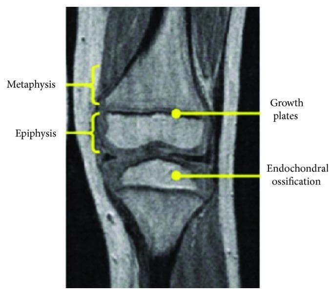 This diagnostic image is a T1-weighted or proton density-weighted MRI scan showing the longitudinal section of a pediatric knee joint, illustrating the key anatomical components of developing long bones. The image specifically highlights the distal femur and proximal tibia. Anatomical structures are identified with yellow labels and brackets: the Metaphysis is shown as the transitioning region of the diaphysis; the Epiphysis is indicated as the rounded end of the bone; and the Growth Plates (physeal cartilage) are visible as thin, dark horizontal bands of low signal intensity separating the metaphysis from the epiphysis. Additionally, an area of Endochondral Ossification is pointed out within the secondary ossification center of the proximal tibia. This image is used for educational purposes to demonstrate pediatric skeletal anatomy, specifically focusing on the maturation of the epiphyseal plate and the development of secondary ossification centers in children, which is critical for assessing bone age and skeletal trauma.