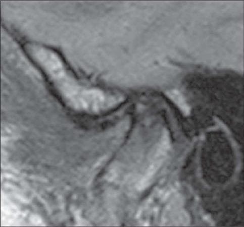 This diagnostic image is a sagittal proton density (PD)-weighted MRI of the temporomandibular joint (TMJ) in a closed-mouth position. The scan illustrates advanced internal derangement characterized by anterior disc displacement. The articular disc, which should normally reside in a biconcave configuration between the mandibular condyle and the temporal bone's articular eminence, is displaced anteriorly. Significant morphological changes indicative of degenerative disc disease are visible, including a loss of the normal biconcave shape, acquiring a more biconvex or rounded contour. The disc demonstrates thinning (tapering) of the anterior band and surface irregularities. Educational focus includes the identification of anatomical landmarks of the TMJ (mandibular condyle, articular eminence, and external auditory canal) and the assessment of disc positioning and morphology for diagnosing temporomandibular disorders (TMD). This content is relevant for intermediate to advanced medical learners in radiology, maxillofacial surgery, and dentistry.