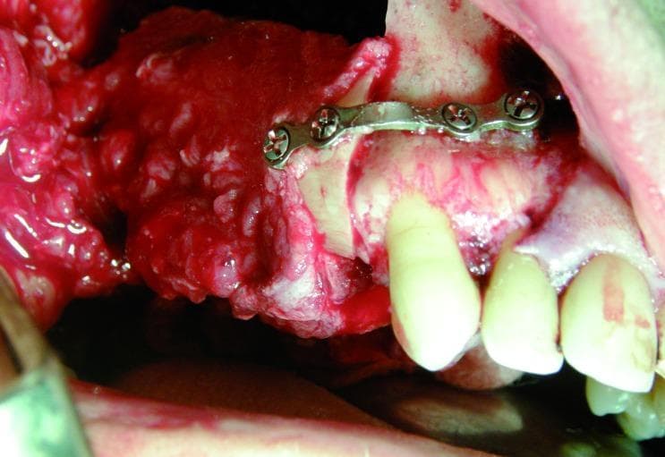 An intraoperative clinical photograph documenting a maxillofacial reconstruction procedure using a vascularized free fibula flap. The image shows the donor fibula segment being integrated into the recipient site (mandible or maxilla). A curved titanium reconstruction mini-plate is prominently visible, spanning the osteotomy site to provide rigid internal fixation between the native bone and the fibula graft. The plate is secured with at least four metallic cortical screws. Adjacent to the surgical site, native teeth are visible, showing proximity to the reconstruction area. The surrounding soft tissues and gingiva appear erythematous and edematous, consistent with acute surgical trauma and perioperative inflammation. This visual illustrates the mechanical fixation and spatial orientation required in microvascular reconstructive surgery for oral cavity defects, often following oncological resection. The focus is on the interface between the hardware, graft, and native anatomical structures.