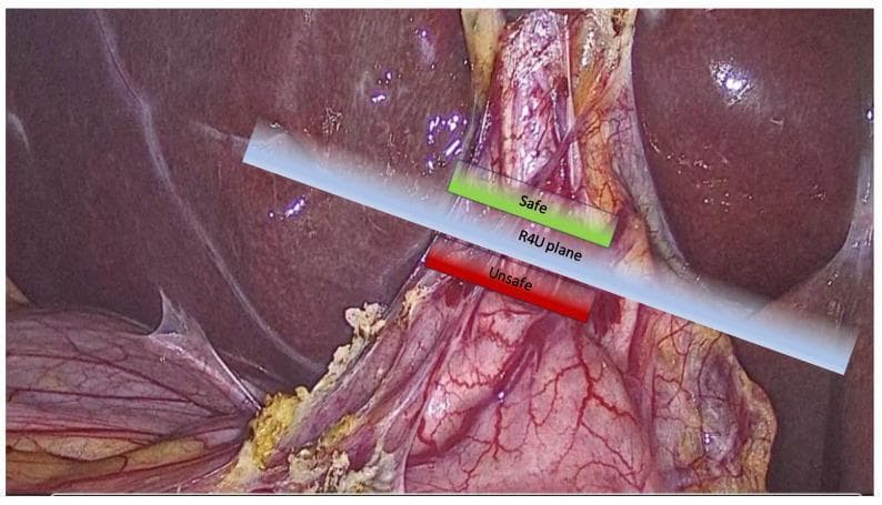 This clinical photograph displays a laparoscopic view of the liver and hepatobiliary region during a surgical procedure, likely a cholecystectomy. An educational overlay illustrates the 'R4U plane,' a conceptual safety boundary used for intraoperative orientation. The R4U plane is depicted as a diagonal, translucent blue transversal plane passing through the level of Rouviere’s sulcus. This plane serves to demarcate 'Safe' vs. 'Unsafe' zones for surgical dissection to prevent iatrogenic bile duct injury. The area cranial (above) to the blue plane is highlighted in green and labeled 'Safe,' indicating where dissection is posterior to the common bile duct plane. The area caudal (below) the plane is highlighted in red and labeled 'Unsafe,' identifying the region containing critical structures like the common bile duct and major vascular pedicles. The image demonstrates the liver parenchyma, cystic pedicle area, and surrounding fatty subserosal tissues, emphasizing the application of cognitive maps in hepatobiliary surgery.