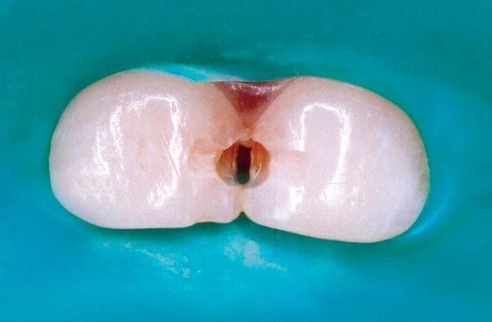 An intraoral clinical photograph displaying a Class III cavity preparation involving the proximal surfaces of the maxillary central primary incisors (teeth 51 and 61). The teeth are isolated using a teal-colored rubber dam to ensure a dry operative field. The central focus is a prepared interproximal cavity at the mesial interface of both teeth. The preparation reveals a deep, rounded void with internal walls showing varied coloration: a dark brown-to-black central area suggestive of remaining carious tissue or stained dentin, and a reddish-pink hue near the gingival aspect possibly indicating proximity to the pulp chamber or gingival tissue. The enamel of the primary teeth appears glossy, translucent, and creamy-white, providing a sharp contrast against the matte rubber dam. This image illustrates pediatric restorative dentistry techniques, specifically the management of proximal caries in primary dentition through operative preparation.