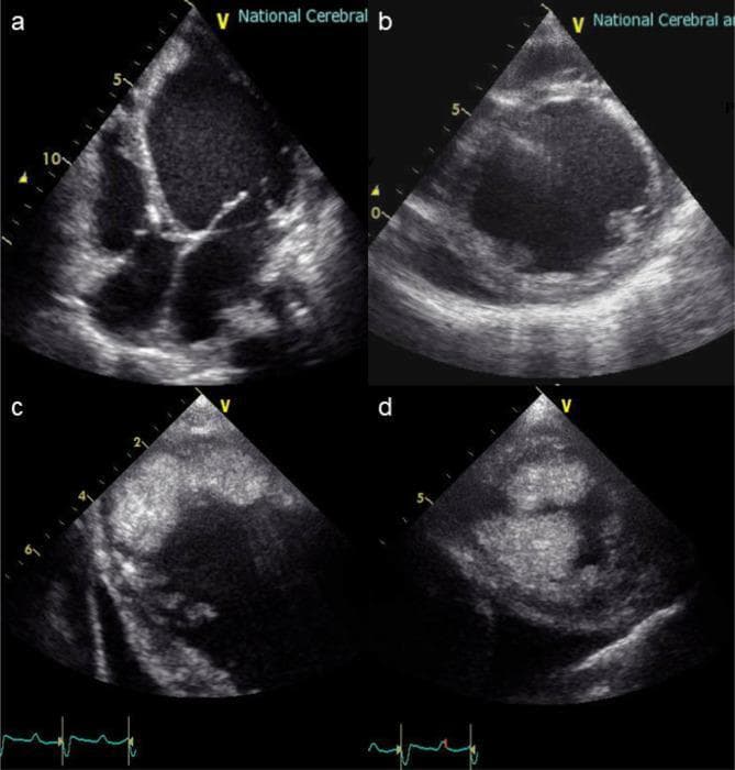 This composite diagnostic image consists of four transthoracic echocardiography (TTE) frames (a-d) showing pathological changes in the heart. Panels (a) and (b) demonstrate severe global dilation of the left ventricle (LV) with noticeable wall thinning, characteristic of advanced dilated cardiomyopathy. The right ventricle appears relatively normal in volume compared to the enlarged LV. Panels (c) and (d) focus on the apical region of the left ventricle, revealing a large, irregular, and heterogeneous echogenic mass adherent to the endocardial surface. This finding is consistent with a massive intracavitary thrombus, a common complication of severely reduced cardiac output and blood stasis in dilated heart failure. The images serve as clinical evidence for preoperative planning prior to ventricular assist device (VAD) implantation, highlighting the risk of embolic events and the necessity for thrombectomy.