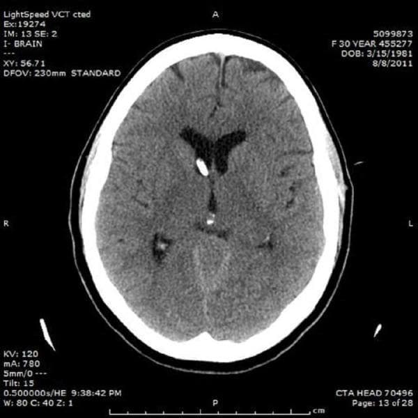 This diagnostic image is an axial non-contrast CT scan of the head demonstrating the placement of a right frontal external ventricular drain (EVD). The EVD is visible as a hyperdense, linear tubular structure traversing the right frontal lobe parenchyma, with its distal tip positioned within the frontal horn of the right lateral ventricle. The ventricular system, specifically the lateral ventricles, exhibits moderate enlargement consistent with acute obstructive hydrocephalus. There is a notable effacement of the cortical sulci, suggesting increased intracranial pressure. The brain parenchyma shows relatively preserved gray-white matter differentiation. This image serves as a clinical illustration of neurosurgical management for cerebrospinal fluid (CSF) diversion in the setting of acute hydrocephalus. Key educational features include the radiological appearance of neurosurgical hardware, ventricular morphology in obstructive disease, and the anatomical trajectory for Kocher's point cannulation.