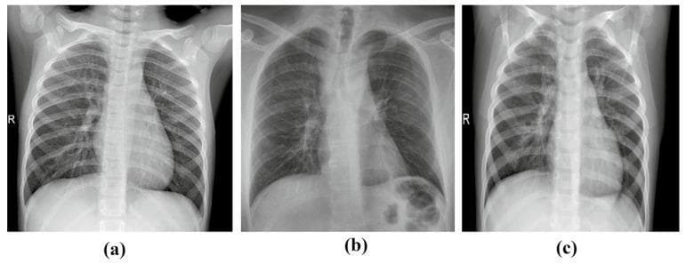 This diagnostic comparison contains three frontal-view chest X-ray radiographs illustrating different clinical conditions: (a) a normal pediatric chest, (b) a COVID-19 case, and (c) a case of bacterial pneumonia. Image (a) demonstrates clear lung fields with normal bronchovascular markings, sharp costophrenic angles, and a distinct heart silhouette. Image (b) shows subtle, patchy opacities and increased interstitial markings characteristic of viral involvement, though the heart and diaphragm remain relatively clear. Image (c) reveals a marked increase in pulmonary opacity and consolidation, particularly in the mid-to-lower lung zones, with obscured diaphragmatic borders indicative of significant fluid or inflammatory exudate. The series serves as a pedagogical tool for distinguishing between healthy respiratory anatomy and different patterns of infectious pulmonary pathology. Visible landmarks across all images include the ribcage, clavicles, spinal column, and cardiac silhouette, providing context for the varying degrees of lung parenchyma lucency and density associated with each diagnosis.
