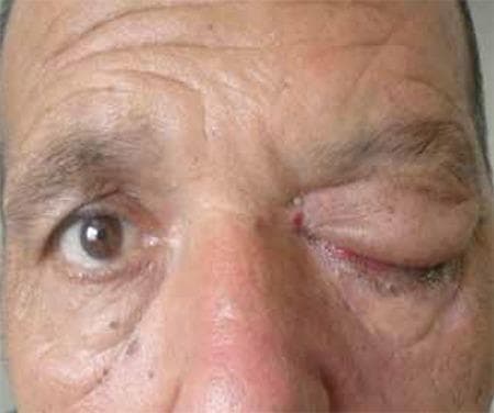 This clinical photograph displays a frontal view of a patient’s mid-face, highlighting a significant asymmetry between the orbits. The patient’s right eye appears unremarkable with normal eyelid position and globe alignment. In stark contrast, the left eye demonstrates severe periorbital pathology characterized by marked proptosis (exophthalmos) and intense inflammatory edema. The left upper and lower eyelids are severely swollen and erythematous, resulting in complete mechanical ptosis that nearly obscures the globe. There is visible crusting along the left lower lid margin and a focal area of hemorrhage or hyperemic tissue at the medial canthus. These clinical findings are consistent with orbital cellulitis or invasive rhino-orbital-cerebral mucormycosis, a diagnosis supported by the associated clinical history of diabetes and ophthalmoplegia. The image serves as an educational example of orbital apex syndrome or cavernous sinus involvement, where inflammatory mass effect leads to proptosis and paralysis of the extraocular muscles and eyelid levators.
