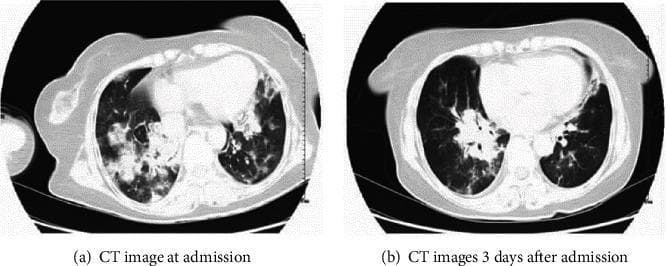 This Comparison Chart features two side-by-side axial non-contrast CT scans of the chest demonstrating the progression of pulmonary complications in a patient with acute carbon monoxide poisoning and aspiration pneumonia. Image (a), taken at admission, shows diffuse bilateral thickening of the lung texture with extensive ground-glass opacities (GGO) and multifocal, high-density nodular and patchy shadows. These abnormalities exhibit fuzzy margins and are predominantly distributed in the inner and middle lung zones, particularly in the upper lobes, resulting in significantly decreased overall pulmonary light transmittance. Image (b), obtained 3 days post-admission, reveals a marked radiological improvement. While some residual patchy shadows and ground-glass opacities persist, the density and extent of the pulmonary edema and inflammatory infiltrates have substantially diminished. This series illustrates the acute parenchymal changes and rapid initial recovery typical of CO-induced toxic pulmonary edema when managed with supportive care. The content is suitable for intermediate to advanced medical students and radiology residents focusing on emergency medicine and pulmonary pathology.