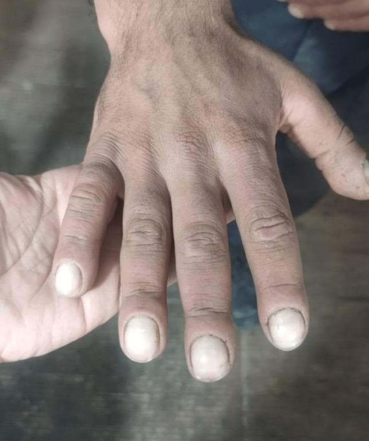 Clinical photograph of a patient's dorsal hand and fingers demonstrating digital clubbing (Hippocratic fingers). The fingernails exhibit a characteristic bulbous enlargement of the distal phalanges, with an increased longitudinal and transverse curvature of the nail plates, giving them a convex, 'watch-glass' appearance. There is an apparent loss of the normal Lovibond angle (the angle between the nail plate and the proximal nail fold). The fingers appear thickened and blunt-tipped. The skin over the hand and knuckles shows prominent creasing and a thickened texture, consistent with pachydermoperiostosis or acromegaly-related changes. This visual finding is a significant clinical sign often associated with chronic hypoxia, pulmonary diseases, cardiovascular conditions, or primary hypertrophic osteoarthropathy.