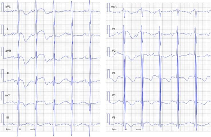 This diagnostic image is a 12-lead electrocardiogram (ECG) including right-sided lead V4R, obtained from a 4-month-old infant with dilated cardiomyopathy. The tracing demonstrates sinus tachycardia with a high ventricular rate. Key pathological features include markedly enlarged QRS amplitudes, particularly evident in the precordial leads (V1-V6) and limb leads (I, aVL), consistent with severe left ventricular hypertrophy. There are widespread ST-segment abnormalities characterized by down-sloping ST-segment depression and T-wave inversion/flattening in the lateral and inferior leads (I, aVL, II, aVF, V4-V6), representing a ventricular strain pattern. The P-waves are enlarged, suggesting atrial enlargement. Additionally, the QT interval is corrected (QTc) and appears prolonged. This ECG illustrates significant myocardial stress and structural remodeling associated with severe heart failure and pediatric cardiomyopathy.