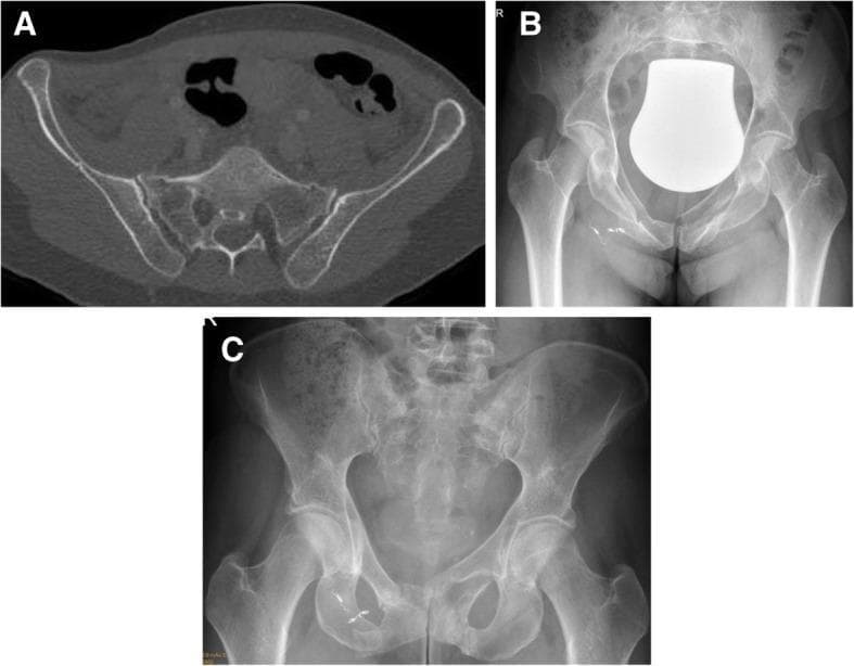 This composite clinical image illustrates the progression and non-operative management of a lateral compression (Type B2) pelvic fracture. Panel A is an axial CT scan of the pelvis showing bilateral sacral fractures involving the sacral alae, a characteristic finding in lateral compression injuries. Panel B is an anteroposterior (AP) pelvic radiograph demonstrating fractures of the superior and inferior pubic rami. Notable interventions include multiple radiopaque embolization coils in the right pelvic region, likely used to control arterial hemorrhage, and a large, bell-shaped radiopaque bladder shield. Panel C is a follow-up AP radiograph taken 6 weeks later, showing evidence of bone consolidation and interval healing of the pubic rami fractures with persistent embolization coils and no surgical hardware. This sequence demonstrates successful non-operative therapy where structural stability is achieved through natural remodeling and conservative management.