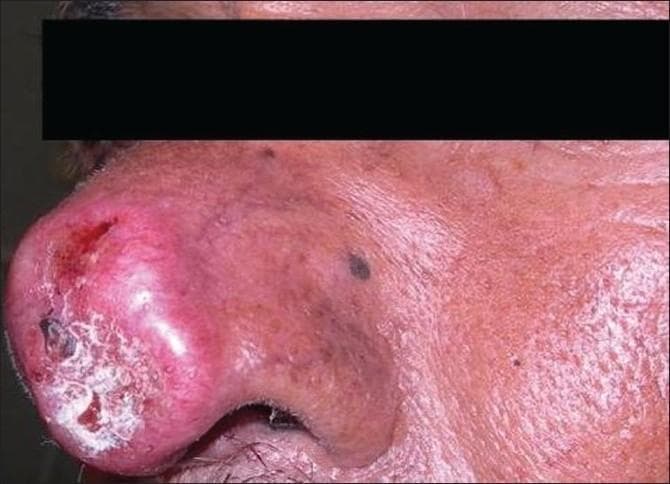Clinical photograph of a patient's face in profile, showing a significant skin lesion on the nasal tip and ala, diagnosed as Lupus vulgaris, a form of cutaneous tuberculosis. The lesion presents as a large, erythematous, and violaceous plaque with prominent inflammation. Key morphological features include central ulceration with visible crusting and white scaling, indicating a chronic, destructive process of the nasal tissue. The surrounding skin of the cheek and bridge of the nose shows secondary changes, including diffuse erythema, thickened texture, and scattered hyperpigmented macules. This image serves as an educational example of the progressive and disfiguring nature of chronic cutaneous tuberculosis when it affects the central facial features, highlighting the characteristic 'apple-jelly' nodules (though not viewed under diascopy) and the resulting tissue destruction common in untreated lupus vulgaris.