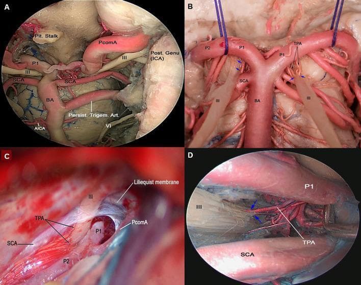 This composite of four clinical images displays endoscopic views and micro-dissections of human cadaveric specimens, focusing on the neurovascular anatomy of the interpeduncular and ambient cisterns. Figure A shows an endoscopic endonasal view featuring a persistent trigeminal artery, a rare fetal anastomosis, connecting the left intracavernous Internal Carotid Artery (ICA) to the basilar artery (BA). Figures B, C, and D demonstrate the detailed vascular supply of the cisternal segment of the oculomotor nerve (CN III). The nerve is seen coursing between the posterior cerebral artery (PCA) and the superior cerebellar artery (SCA). Key educational focus is placed on the thalamoperforating arteries (TPA) arising from the pre-communicating (P1) segment of the PCA, which provide the primary blood supply to this segment of CN III (indicated by blue arrows). Significant anatomical landmarks shown include the pituitary stalk, Liliequist's membrane, posterior communicating artery (PcomA), and the anterior inferior cerebellar artery (AICA). This material serves as an advanced anatomical reference for neurosurgical planning and neurovascular education.