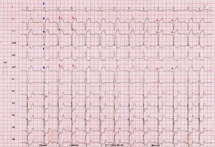 This diagnostic image is a 12-lead electrocardiogram (ECG) demonstrating multiple acute and chronic conduction abnormalities consistent with a multi-vessel or proximal culprit coronary artery occlusion. The tracing shows a Right Bundle Branch Block (RBBB) combined with Left Axis Deviation (LAD), indicated by qR complexes in leads I and aVL and rS complexes in inferior leads (II, III, aVF), diagnostic of a co-existing Left Anterior Hemiblock (LAHB). Acute pathology is evident by significant ST-segment elevation (approximately 3 mm) in the inferior leads (II, III, aVF), representing an acute inferior ST-elevation myocardial infarction (STEMI). Furthermore, the precordial leads (V1-V6) exhibit downsloping ST-segment depression. In V1 and V2, the presence of tall R waves (R/S ratio > 1) alongside ST depression is highly suggestive of a concomitant posterior wall myocardial infarction. The PR interval is approximately 200 ms. These combined findings signify extensive myocardial ischemia/infarction involving the inferior and posterior walls with significant trifascicular system involvement.