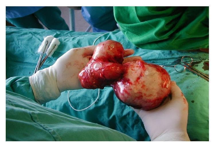 A clinical photograph captures a large, surgically removed complex hydatid cyst (Echinococcus granulosus) from a human liver. The specimen is held by a surgeon's gloved hands in an operating room environment, characterized by green surgical drapes and visible instruments including surgical scissors and forceps with swabs. The cyst complex is a multi-lobed, bilobed structure consisting of two primary masses connected by a narrower bridge of tissue. One lobe is larger and more spherical with a pearly-white or translucent laminated membrane appearance, typical of a hydatid cyst, while the other is more irregular and displays significant erythematous vascularization and adherent bloodstains. The surface of both lobes is glistening and moist, with small, bubble-like daughter cysts potentially visible beneath the capsule. This image serves as an educational example of advanced liver hydatid disease requiring surgical intervention, illustrating the size and morphology of a large hepatic cyst (LHC) and the surrounding surgical context.