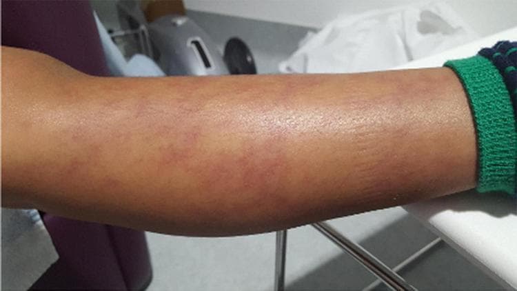 This clinical photograph displays a patient's forearm demonstrating livedo racemosa, a distinctive dermatological sign characterized by a persistent, broken, and irregular reticular (net-like) pattern. The rash consists of reddish-purple to violaceous discoloration that forms an asymmetric, branching network across the skin. Unlike livedo reticularis, which typically presents as complete circles, the patterns here are open and irregular in shape. The surrounding skin appears otherwise normal in texture, though the vascular pattern creates a mottled, non-uniform appearance. Clinically, this visual finding is a hallmark of vasculopathy and systemic inflammatory conditions, such as Deficiency of Adenosine Deaminase-2 (DADA2). It represents compromised blood flow in the medium and small vessels of the dermis and subcutis. This image is an educational example of autoinflammatory skin manifestations used to differentiate between benign physiological livedo and pathological vasculitic processes in a pediatric or adult rheumatology context.