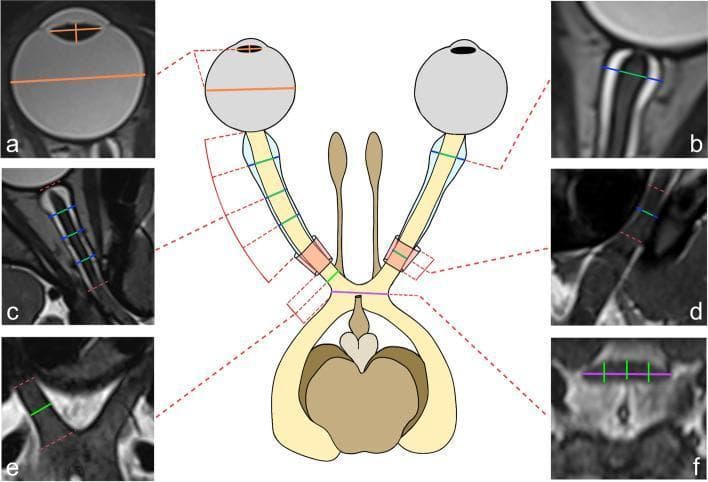 This composite educational resource consists of a central schematic diagram and six corresponding axis-corrected magnetic resonance (MR) images (labeled a-f) illustrating the anterior visual pathway anatomy and measurement protocols. The central diagram depicts the bilateral eyes, optic nerves, and optic chiasm, with dashed red lines indicating the planes of multiplanar reformation (MPR). The accompanying high-resolution T2-weighted FSE images demonstrate specific measurement sites: (a) axial plane of the globe showing the transverse diameter and lens dimensions; (b) the retrobulbar optic nerve and nerve sheath segment; (c) the intraorbital segment with triple-point diameter measurements; (d) the intracanalicular segment within the optic canal; (e) the intracranial optic nerve segment; and (f) a coronal reformation of the optic chiasm showing transverse and superoinferior diameter markings. Clinical relevance focuses on pediatric neuroimaging for establishing normative reference values for visual pathway structures, useful in monitoring intracranial pressure (via optic nerve sheath diameter) and assessing congenital or developmental optic pathway abnormalities.