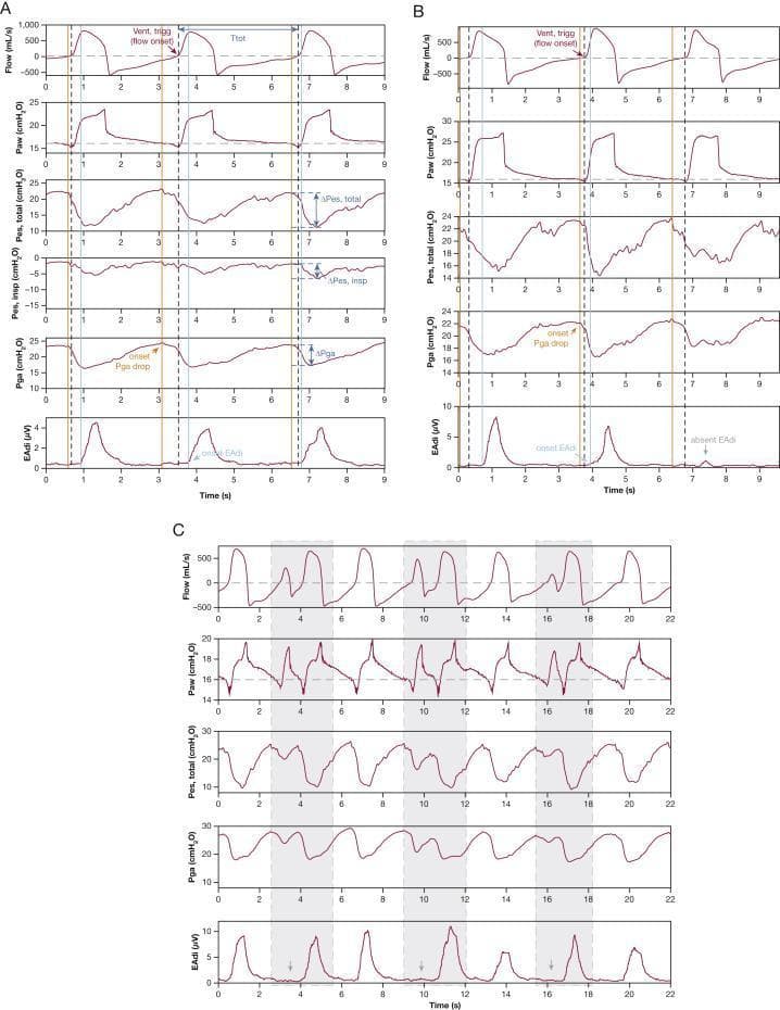 This physiological waveform set demonstrates expiratory muscle relaxation-induced ventilator triggering (ERIT) in a sedated patient. Panels A, B, and C show multi-channel tracings including Flow, airway pressure (Paw), total esophageal pressure (Pes,total), gastric pressure (Pga), and electrical activity of the diaphragm (EAdi).
Key features illustrated include:
- Temporal dissociation: In Panel A, the orange line indicates the onset of Pga drop (expiratory muscle relaxation) which precedes the black dashed line (ventilator triggering), while the light blue line (EAdi onset) occurs after triggering. This confirms the ventilator is triggered by abdominal muscle relaxation rather than neural inspiratory effort.
- Dyssynchrony patterns: Panel B shows ERIT breaths without subsequent diaphragm activity (absent EAdi). Panel C highlights a 2:1 double-triggering pattern (gray areas) where partial expiratory relaxation triggers a first breath without EAdi, followed by complete relaxation triggering a second breath with true inspiratory effort.
- Clinical significance: The diagrams provide a diagnostic methodology for identifying non-diaphragmatic ventilator triggering using esophageal and gastric pressure monitoring in critical care settings.