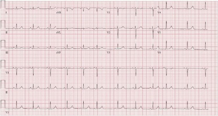 A standard 12-lead electrocardiogram (ECG) displayed on a red grid background with calibration markers. The tracing includes limb leads (I, II, III), augmented limb leads (aVR, aVL, aVF), and precordial leads (V1-V6), with additional rhythm strips at the bottom for leads VI, II, and V5. The ECG demonstrates a normal sinus rhythm with narrow QRS complexes and consistent P waves preceding each QRS. In the limb leads, the QRS axis is normal with predominantly positive deflections in leads I, II, III, aVL, and aVF, and a negative deflection in lead aVR. Precordial lead analysis shows normal R-wave progression from V1 through V6, characterized by small R waves and deep S waves in V1-V2 transitioning to dominant R waves in V5-V6. ST segments are generally isoelectric without acute ST-elevation or significant depression. T-waves are upright in the lateral and inferior leads, with inversion noted in aVR. The tracing lacks evidence of acute ischemic changes, significant arrhythmias, or conduction blocks, serving as an educational example of a baseline ECG in a clinical setting.
