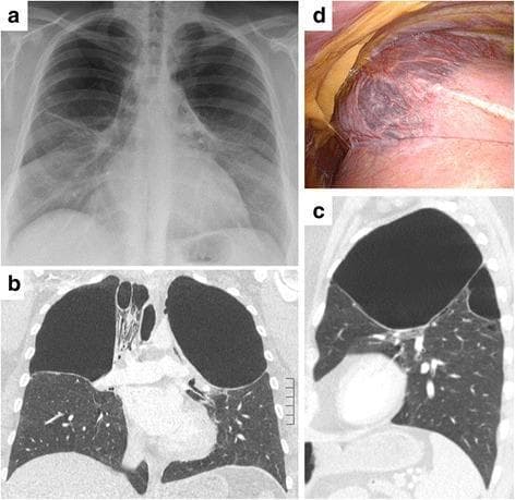 This composite figure illustrates giant apical bullous lung disease through multiple modalities: a posterior-anterior chest X-ray (a), coronal Computed Tomography (CT) scans (b, c), and an intraoperative photograph (d). The radiological images (a-c) demonstrate large, symmetrical, bilateral, and thin-walled bullae located at the pulmonary apices. These air-filled spaces occupy approximately one-third to one-half of the upper thoracic cavity, causing compression of the underlying functional lung parenchyma. The CT scans highlight the sharp demarcation between the hyperlucent bullae and the relatively preserved lower lung lobes. The intraoperative photograph (d) provides a macroscopic view of the right upper lobe, showing a large, distended, dark-colored apical bulla with a thin, translucent wall and visible surface vascularization. The surrounding lung tissue appears relatively healthy in texture. This sequence is representative of severe bullous emphysema, requiring surgical intervention such as thoracoscopic bullectomy to relieve dyspnea and improve respiratory mechanics. Educational focus includes recognizing the radiographic signs of giant bullae versus pneumothorax and understanding their surgical correlation.